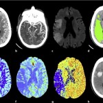 Head Start as an Heuristic For Medical Students, Treatment of Strokes, and the Law of Unintended Consequences