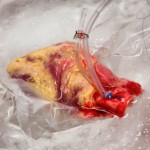 Mozart, Verdi, and Heart Transplantation