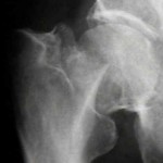 Biomarkers and Hip Fractures
